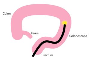 Flexible Sigmoidoscopy | Midland Gastroenterology